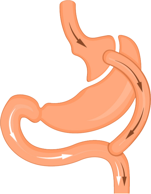 Gastric Bypass Surgery Diagram