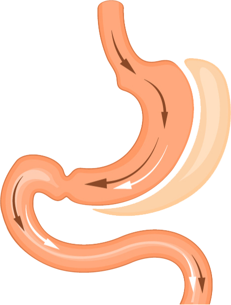 Diagram of Gastric Sleeve Surgery