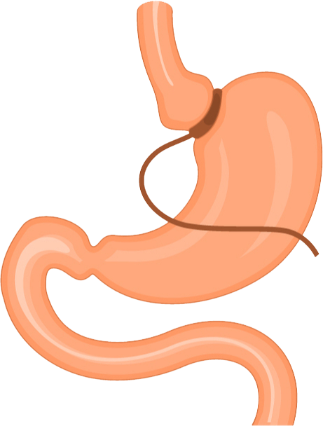 Lap Band Surgery Diagram