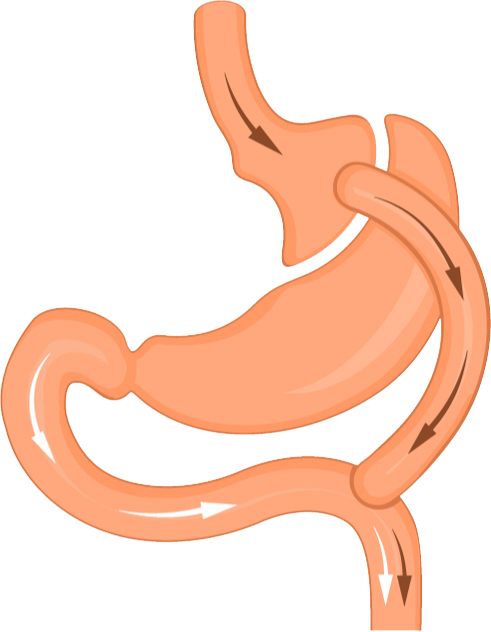 Gastric Bypass Surgery Diagram