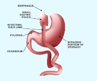 Bariatric Surgery Safe